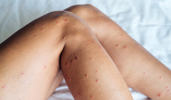 d-bedbug